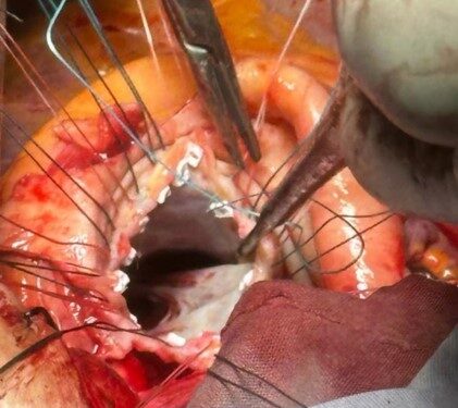 Realiza SESA con éxito procedimiento de cirugía a corazón abierto en el Hospital General de Querétaro