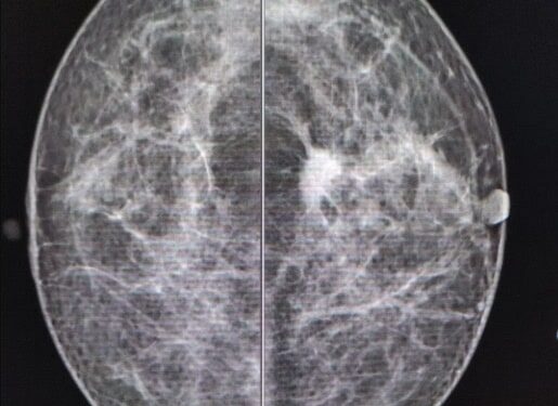 Recomienda la Secretaría de Salud acciones para detección oportuna del Cáncer de Mama