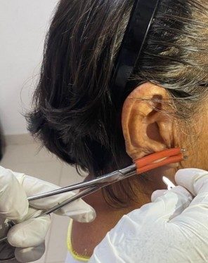 Sin casos nuevos de lepra en Oaxaca